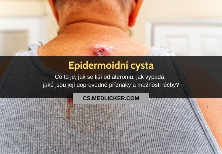 Epidermoidní cysta: vše co potřebujete vědět!
