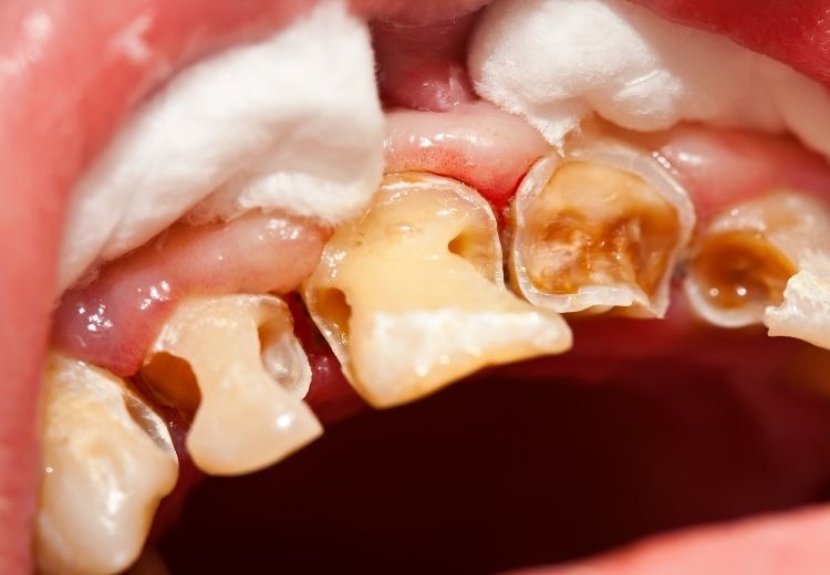Častou příčinou černání zubů je zubní kaz. U dětí může být tento problém způsoben i takzvaným lahvovým kazem.