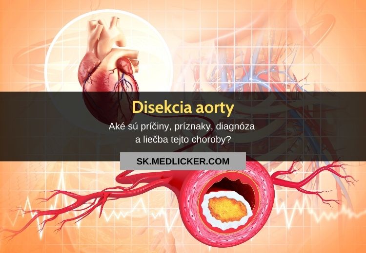 Disekcia aorty: všetko, čo potrebujete vedieť!