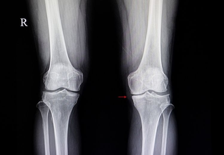 Mírné známky subchondrální sklerózy na kolenním kloubu