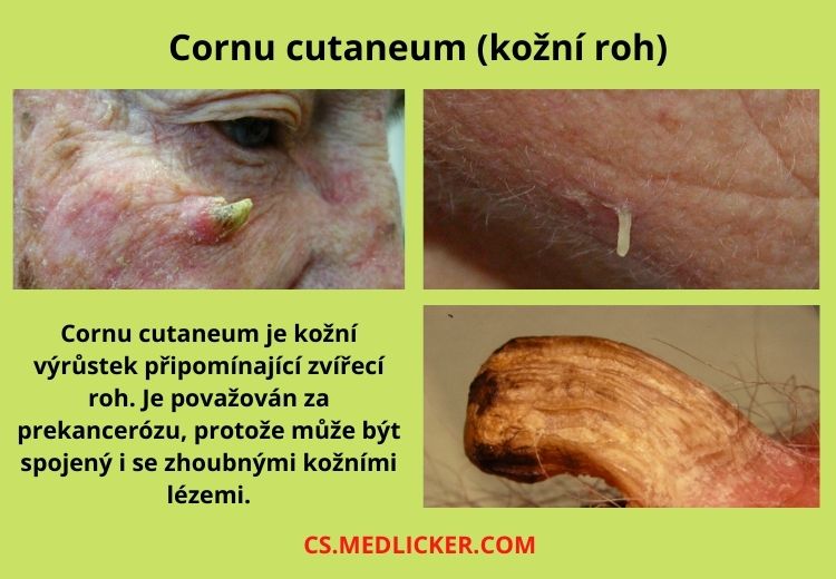 Cornu cutaneum je kožní výrůstek, který svým tvarem připomíná zvířecí roh. Patří mezi prekancerózy, protože se někdy může zvrhnout v maligní kožní nádor.