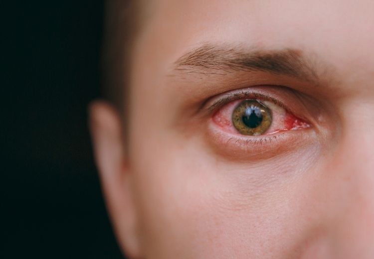 Mezi časté příznaky poškrábání rohovky patří zarudnutí a slzení oka, silná řezavá bolest a zvýšená citlivost na světlo.
