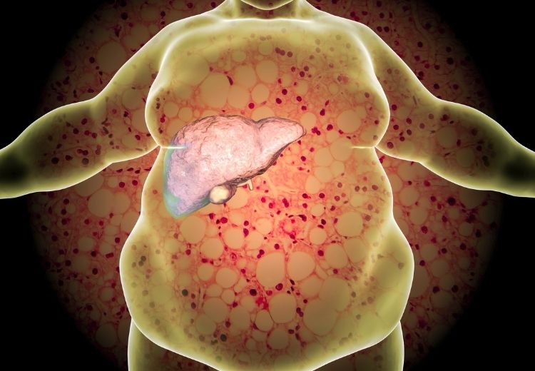 Steatóza jater je jednou z častých příčin hepatopatie, dělíme jí na alkoholovou a nealkoholovou