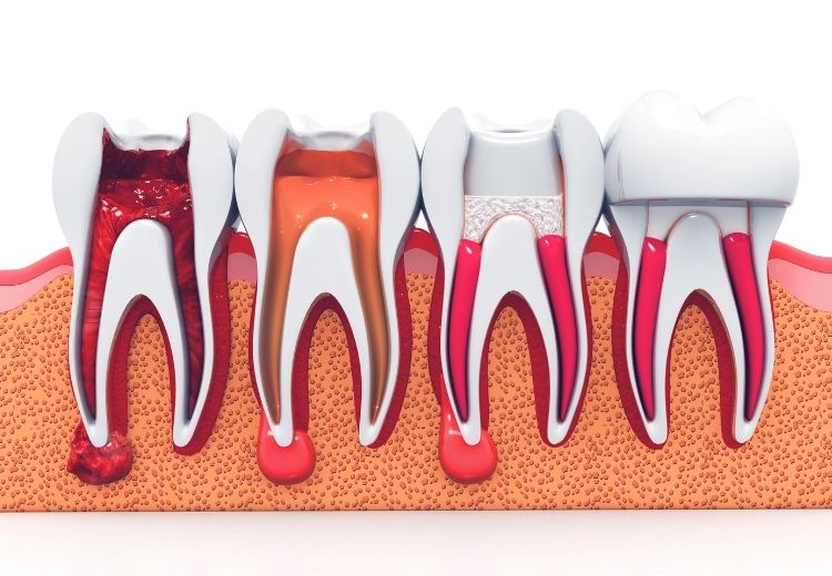 Metodou volby v léčbě odumřelého zubu je ošetření kořenových kanálků (endodoncie)