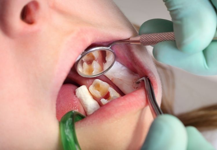 Nejčastější příčinou odumření zubu je dlouhodobě neléčený zubní kaz