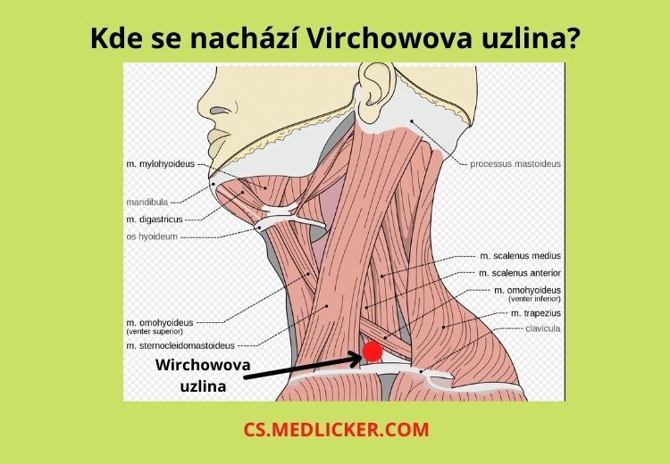 Virchowova uzlina se nachází nad levou klíční kostí a je součástí skupiny supraklavikulárních uzlin