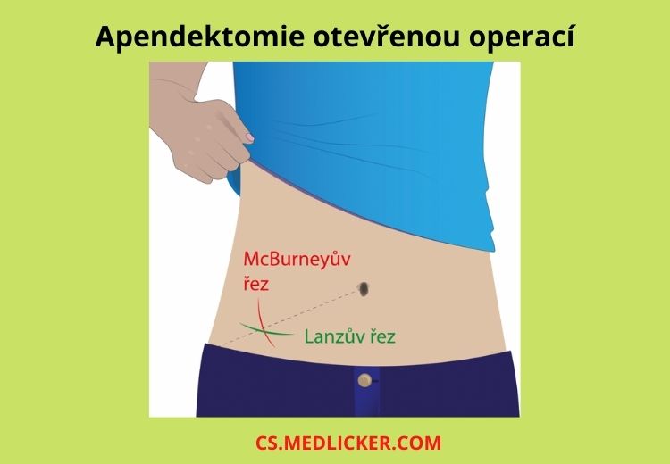 Apendektomie z laparotomie se provádí střídavým řezem, kterým se otevře dutina břišní v pravém podbřišku