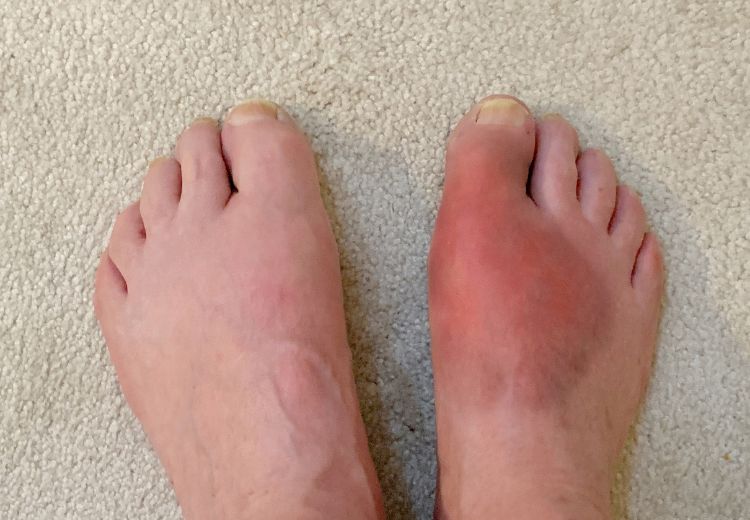 Častým příznakem dny jsou otoky a bolest kořenového kloubu palce nohy