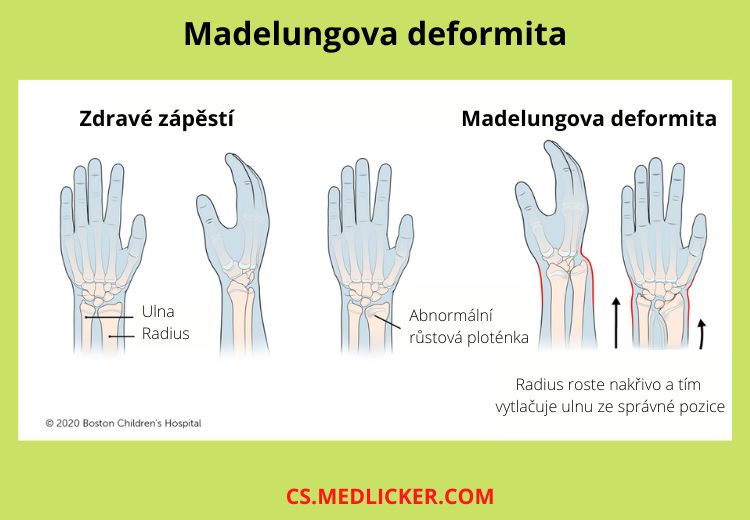 Madelungova deformita způsobuje abnormální postavení zápěstí kvůli defektu růstové ploténky radia (vřetenní kosti)