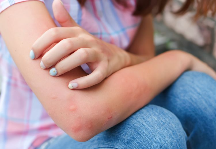 Kopřivka je častým kožním projevem alergií a přecitlivělostí, včetně alergie na borůvky