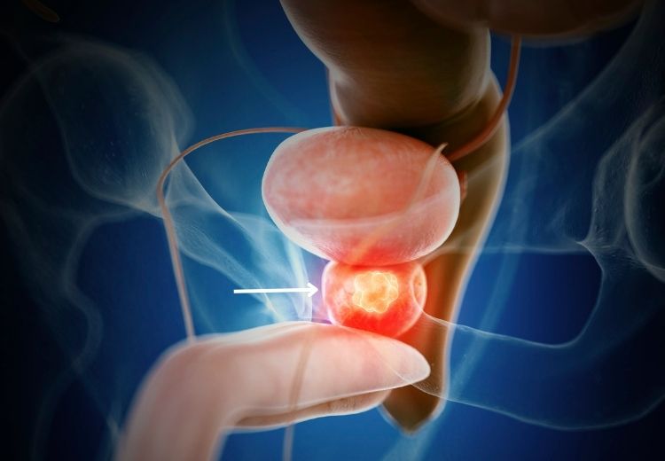 Prostatitida (zánět prostaty) je častou příčinou bolestí v podbřišku u mužů nad 50 let