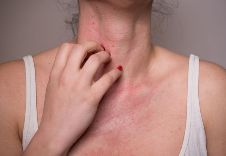Zarudnutí kůže (erytém) a kopřivka patří mezi časté projevy alergie