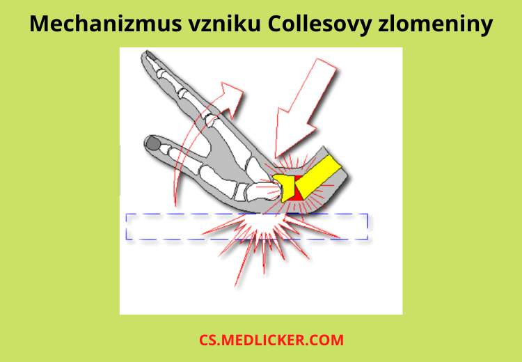 Jakým mechanizmem vzniká Collesova zlomenina (fraktura distálního radia s dorzální angulací)?