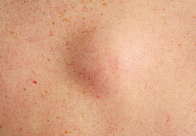 Lipom je nejčastějším benigním nádorem dospělých a může se objevit i na hlavě, jako nebolestivá bulka ve stejné barvě jako okolní kůže