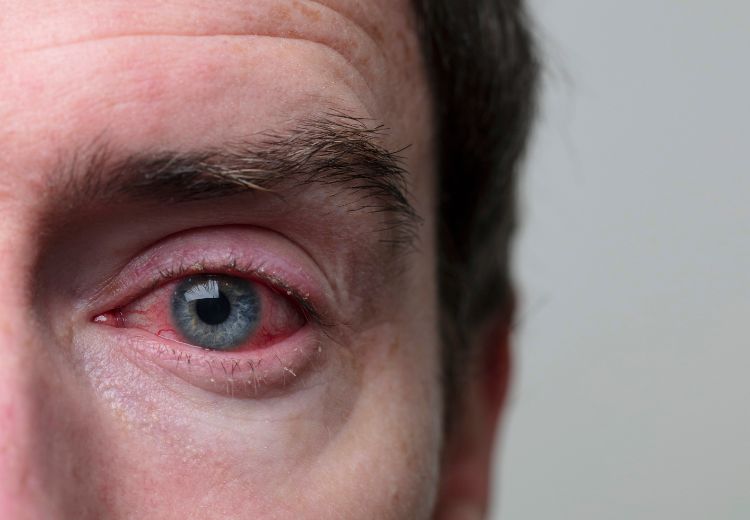 Zarudnutí oka je častým příznakem stafylokokového či jiného zánětu spojivek