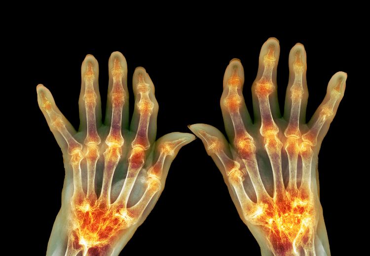 Pacienti s revmatoidní artritidou mají vyšší riziko Sjögrenova syndromu